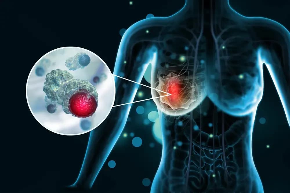 prevent-the-return-of-breast-cancer.3.webp