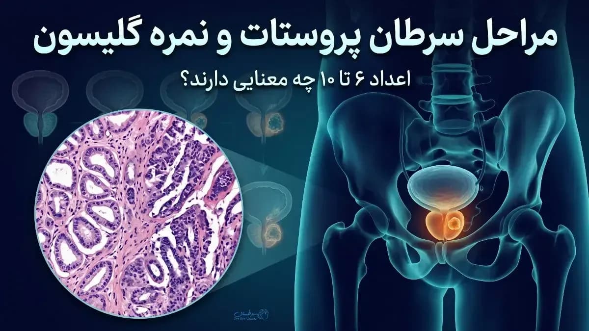 مراحل سرطان پروستات و نمره گلیسون