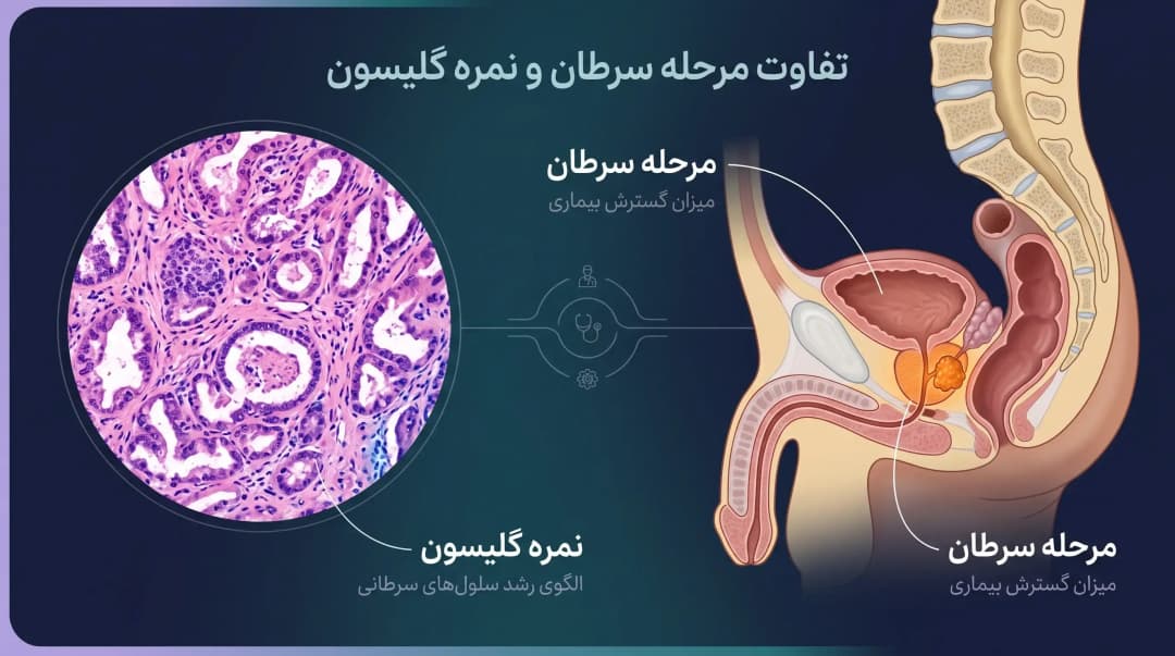 مراحل سرطان پروستات و نمره گلیسون
