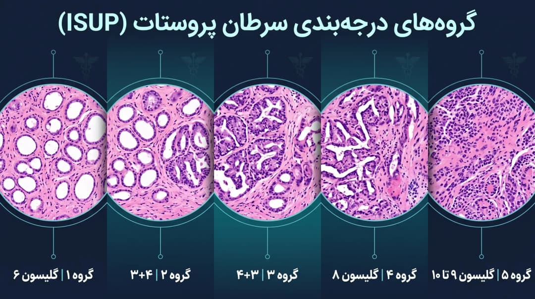 مراحل سرطان پروستات و نمره گلیسون