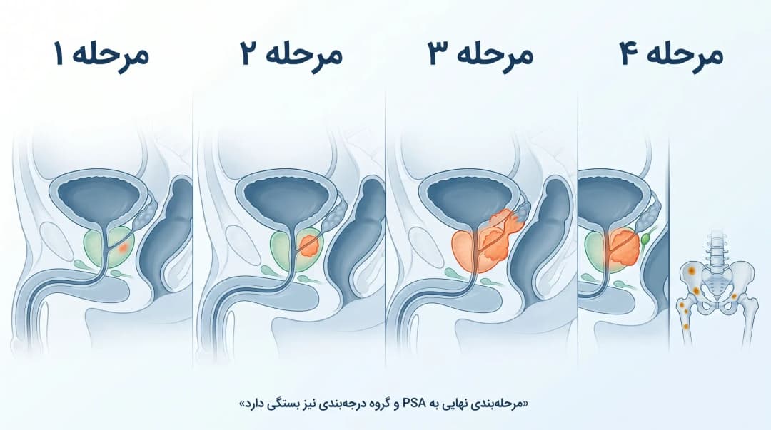 مراحل سرطان پروستات و نمره گلیسون