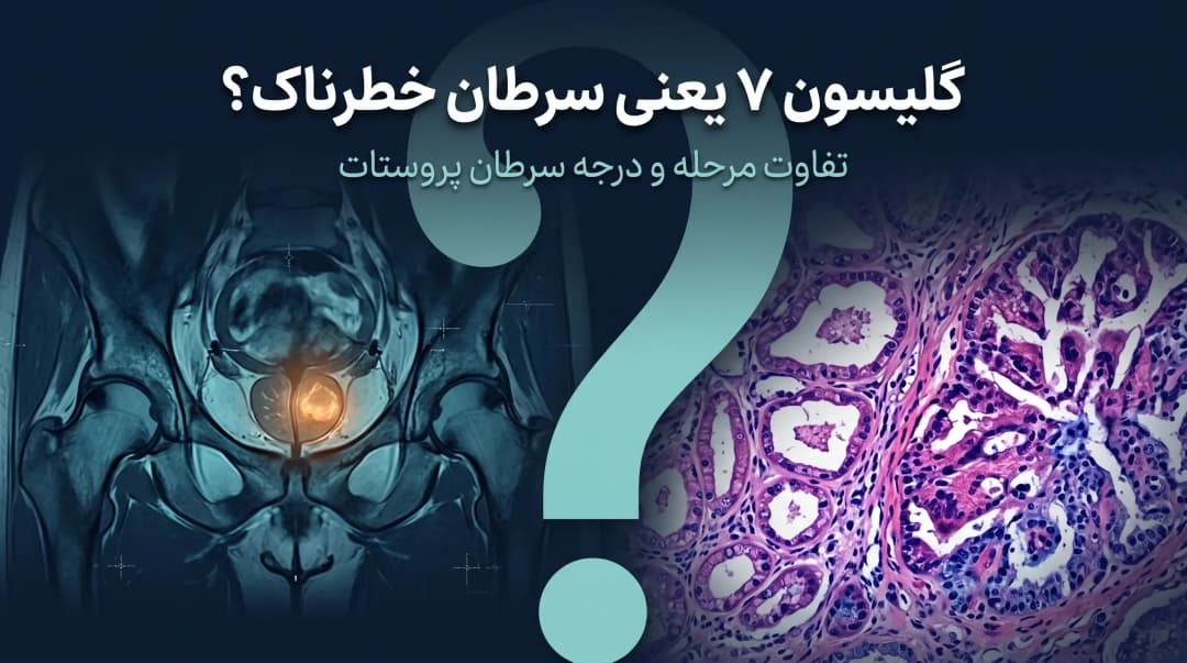 مراحل سرطان پروستات و نمره گلیسون