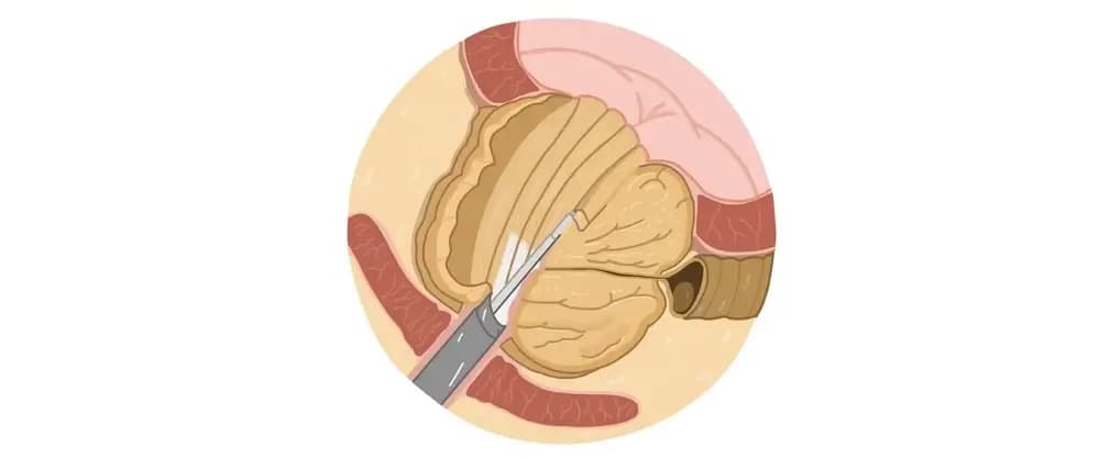 prostatectomy.webp