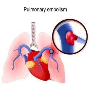 pulmonary-embolism-300x300.webp