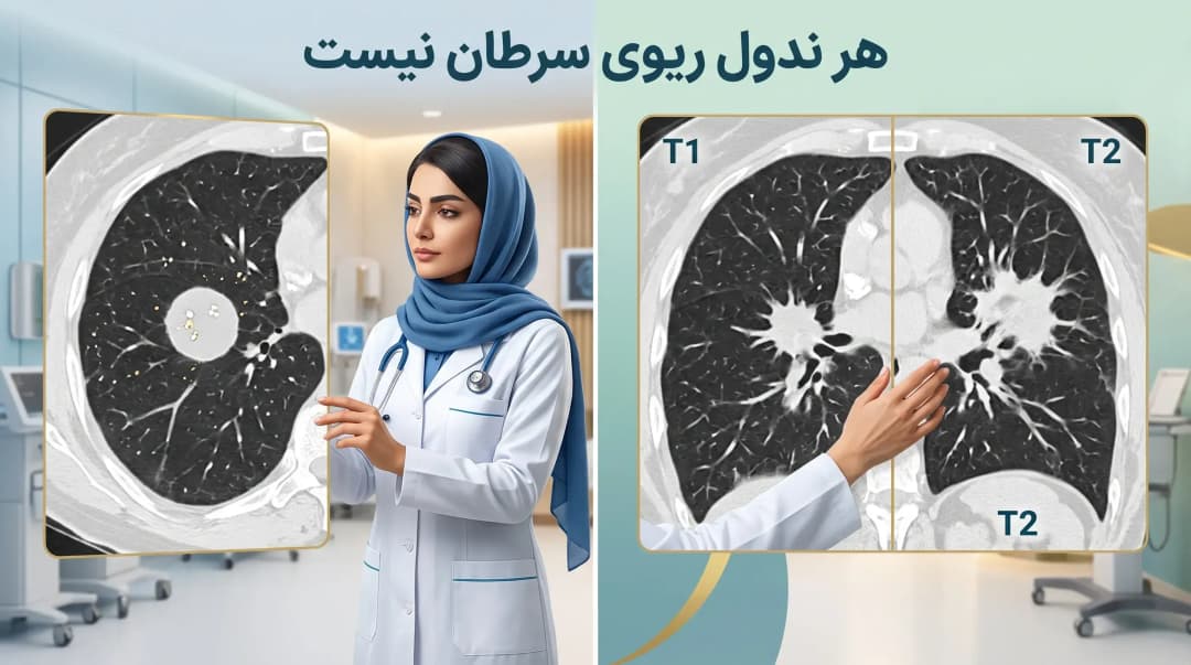 ندول ریوی