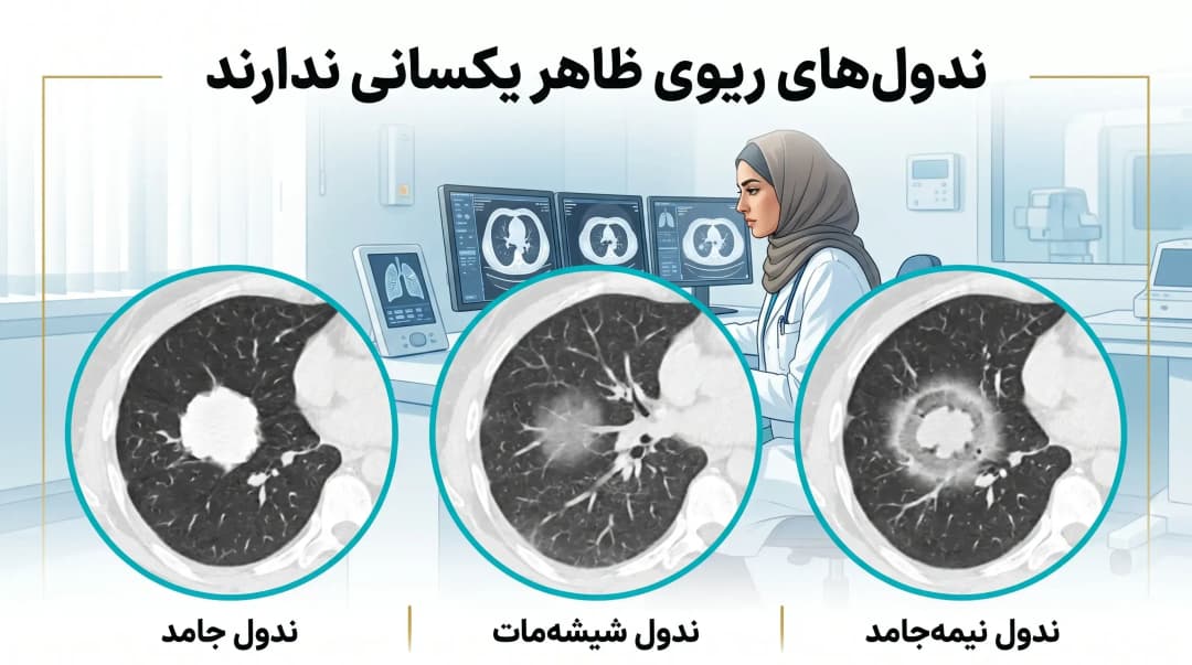 ندول ریوی
