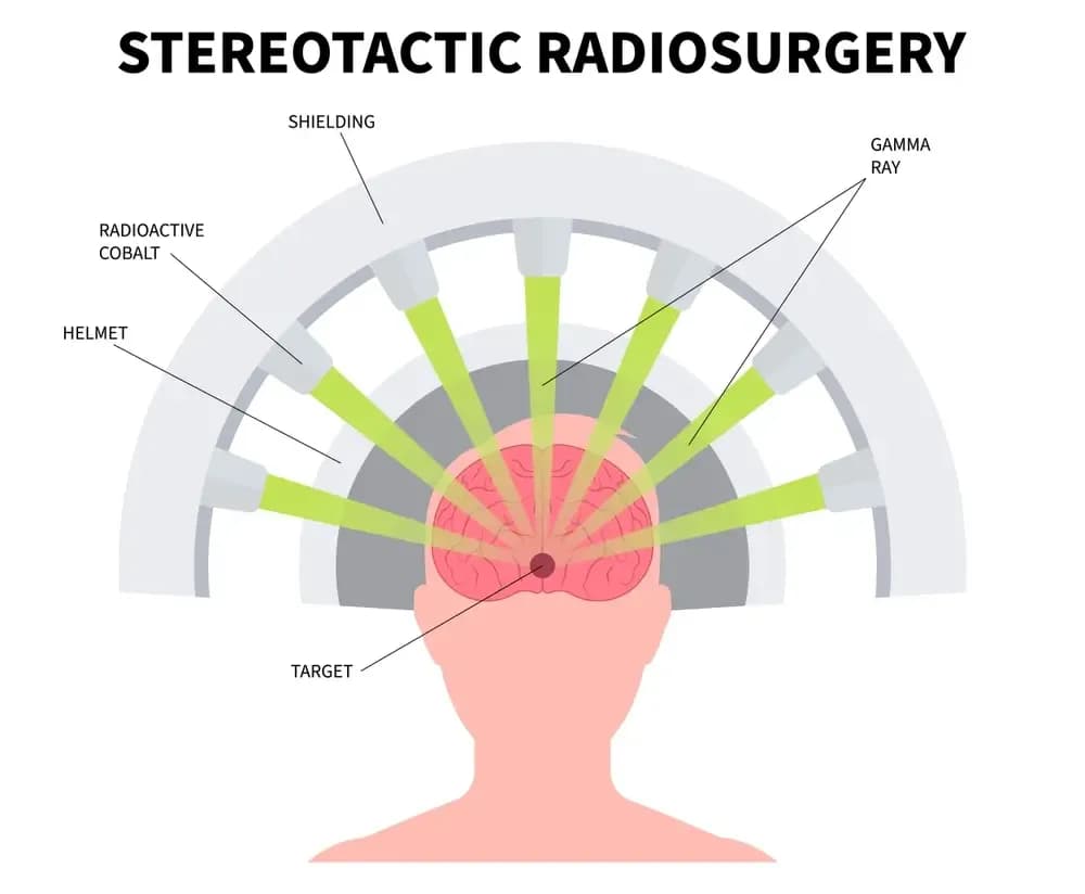 radiosurgery-technique.webp