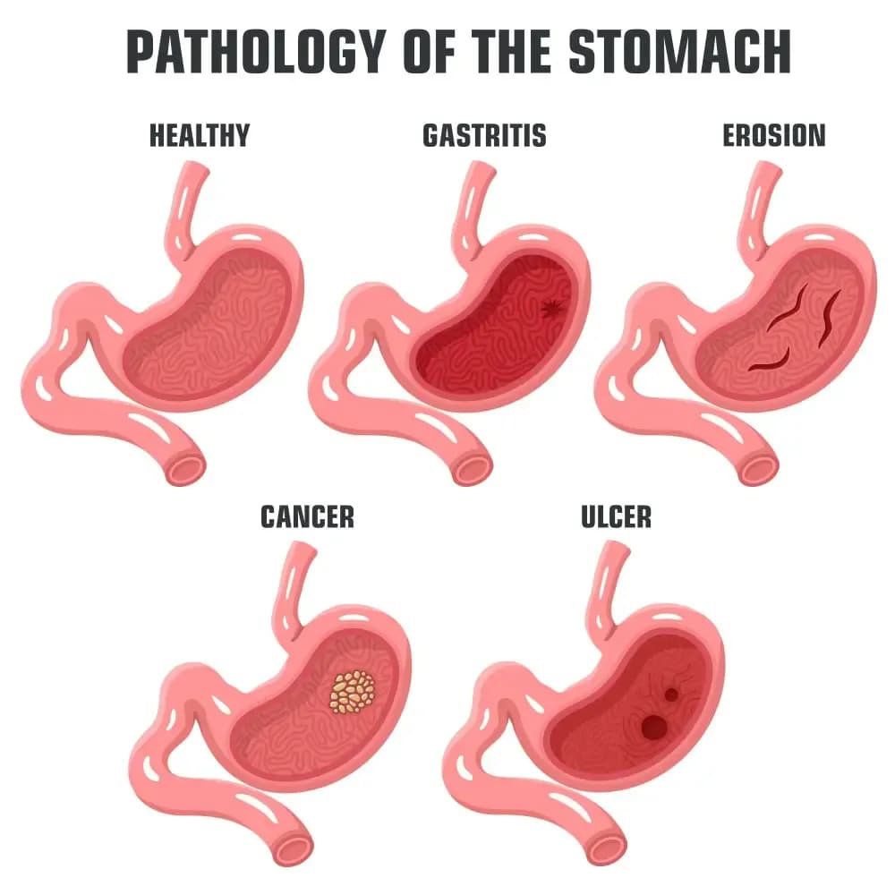 stomach-ulcer-and-stomach-cancer.webp