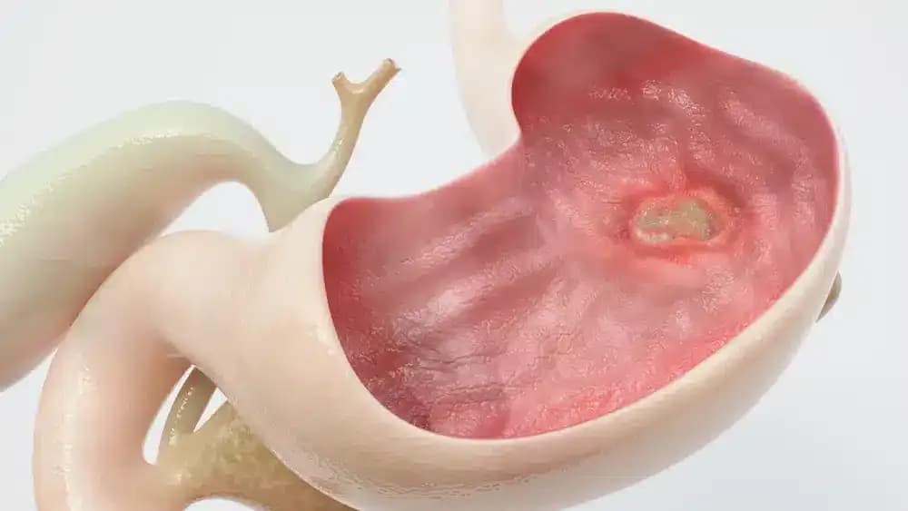 stomach-ulcer.1.webp