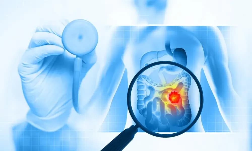 the-best-colon-cancer-surgeon.webp