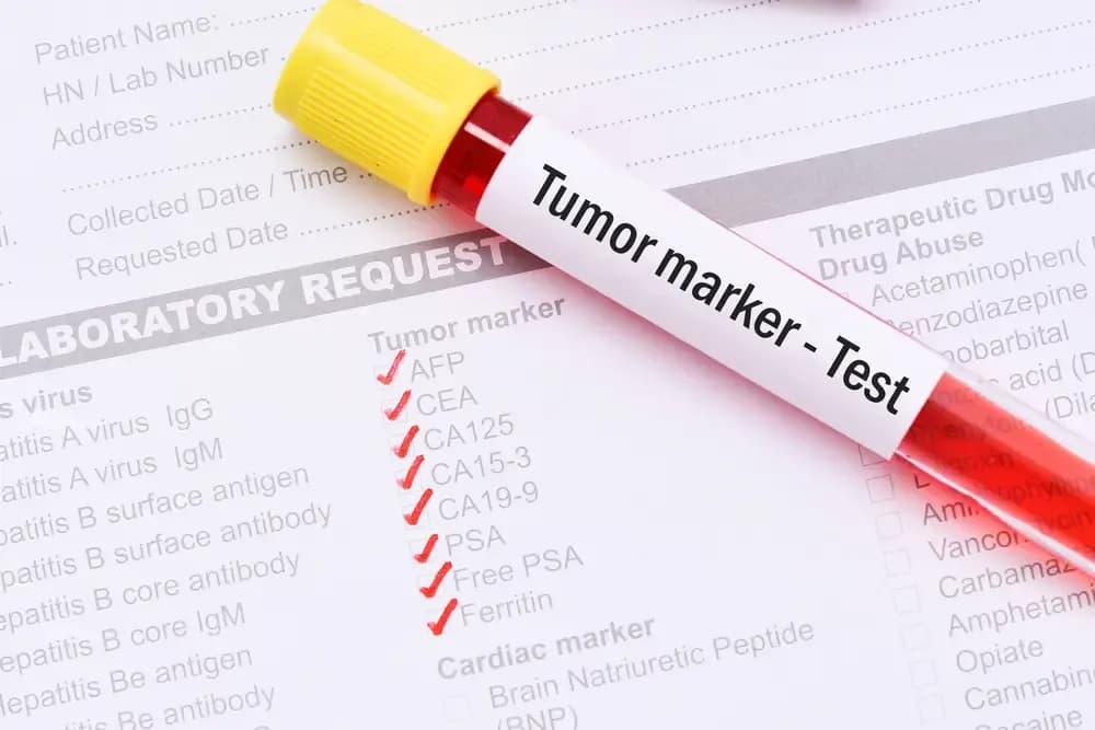 tumor-marker.1.webp