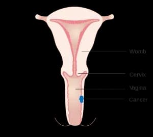 vaginal-cancer-treatment-300x269.webp
