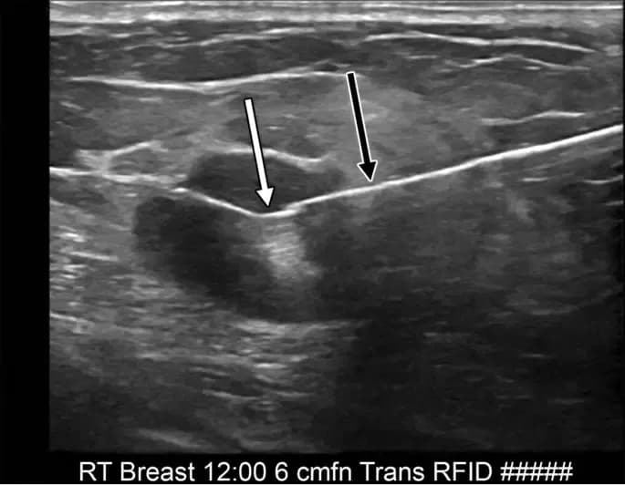wire-placement-in-the-breast.1.webp