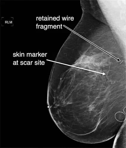 wire-placement-in-the-breast.2.webp