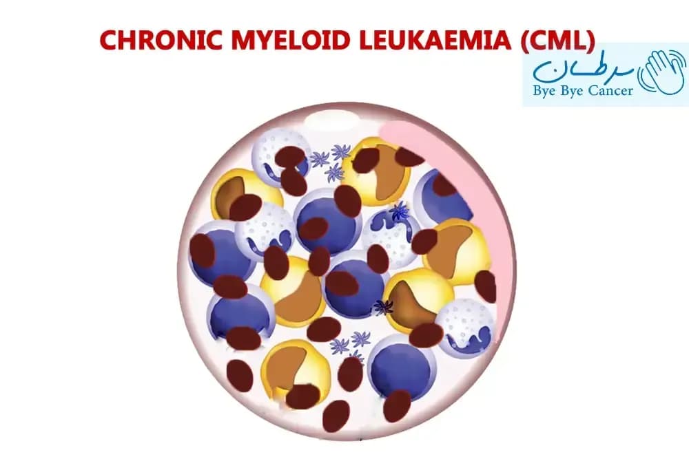 کنترل سرطان CML