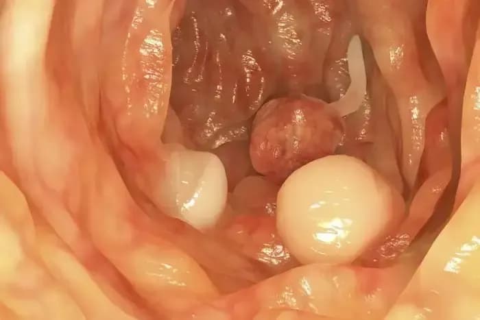 Colon-polyps1.webp