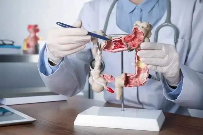 Colon-polyps3.webp