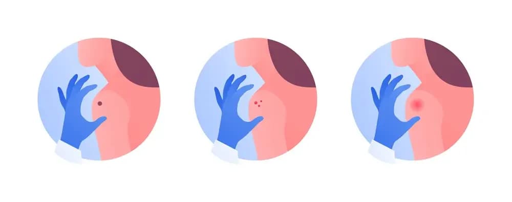 acne-and-cancer.1.webp
