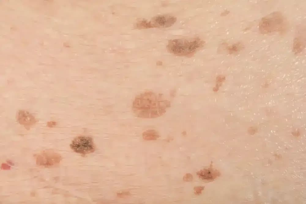 cancer-and-acne.1.webp