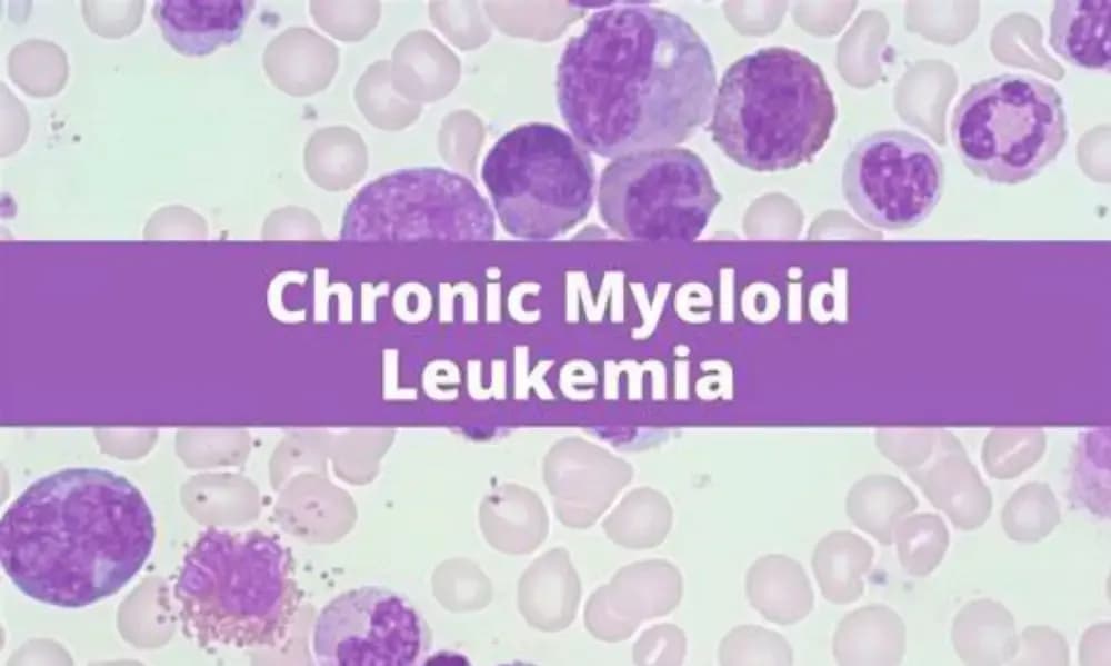 diagnosis-of-CML-cancer.webp