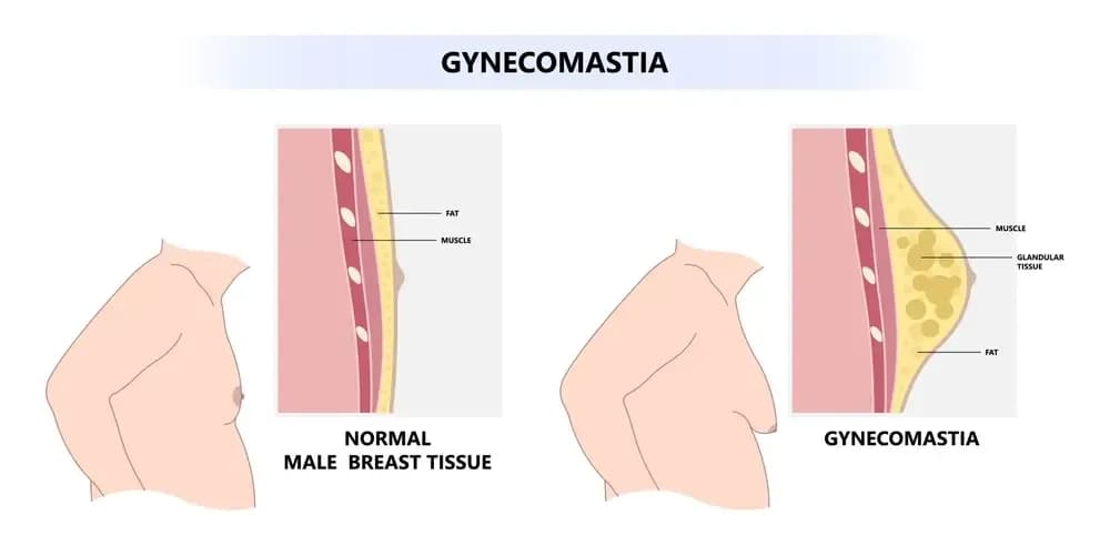 diagnosis-of-gynecomastia.1.webp