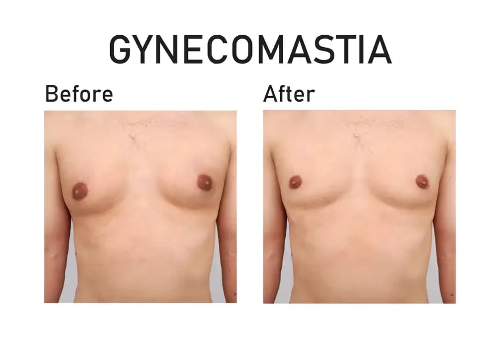 diagnosis-of-gynecomastia.webp