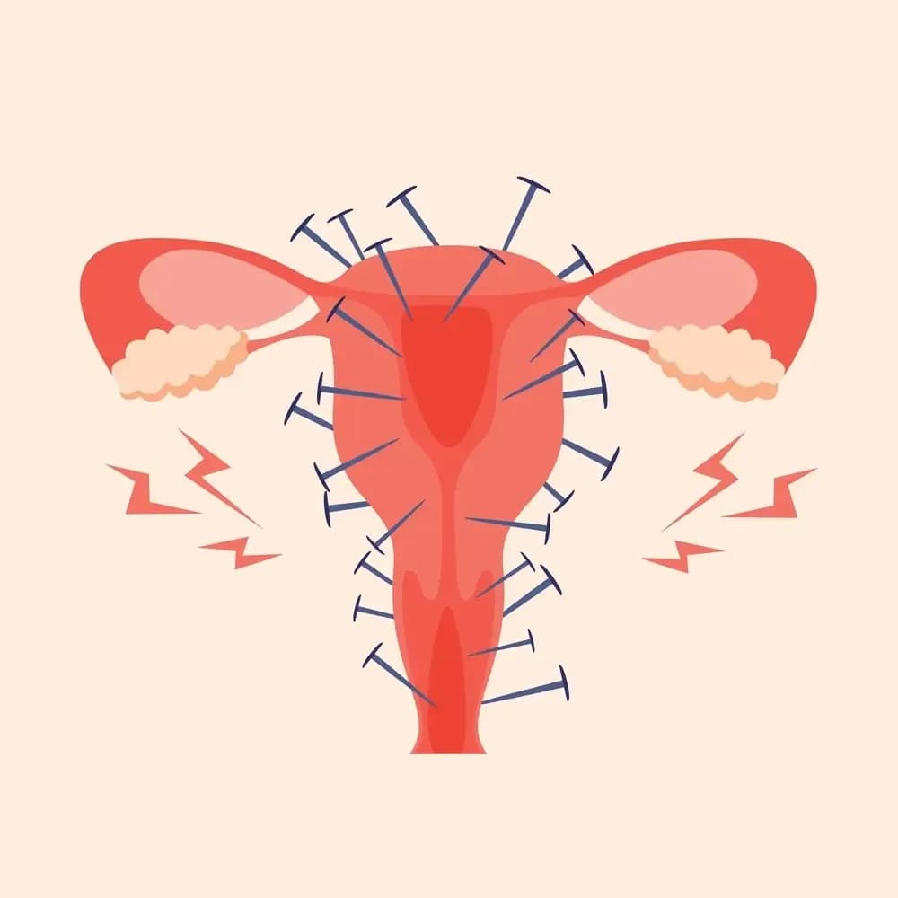 endometriosis-disease.1.webp