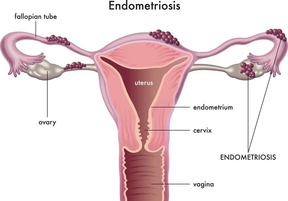 endometriosis.1.webp