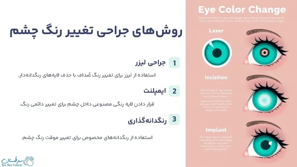 eye-color-change-surgery.2-1024x576.webp