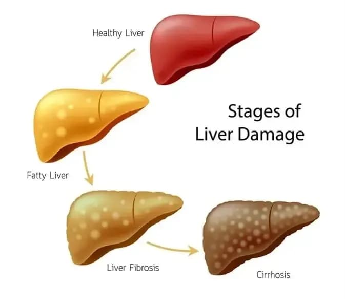 grade-4-fatty-liver.1.webp