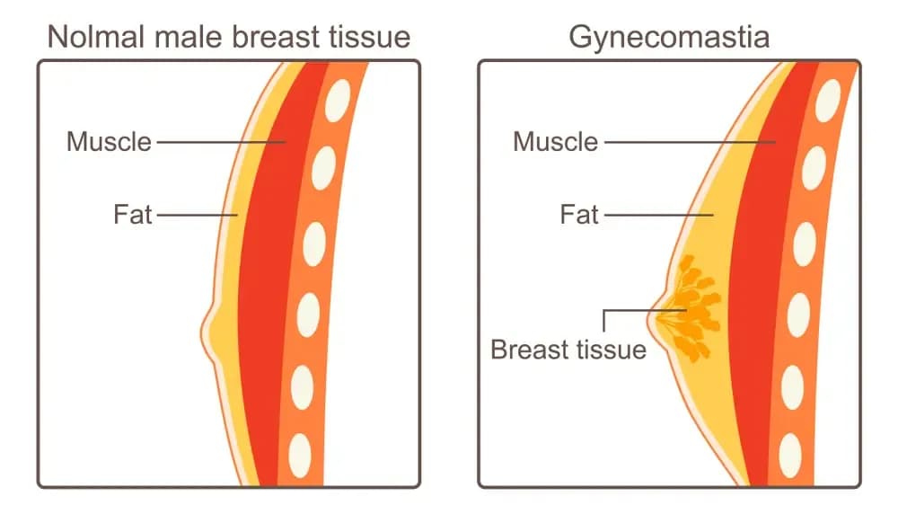 gynecomastia-and-cancer.1.webp