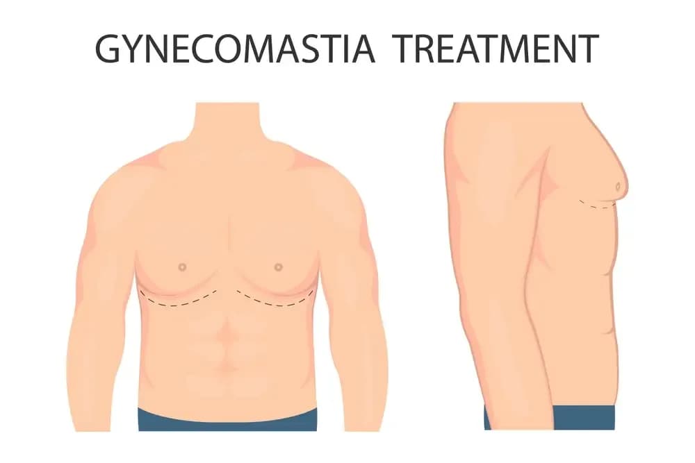 gynecomastia.1.webp