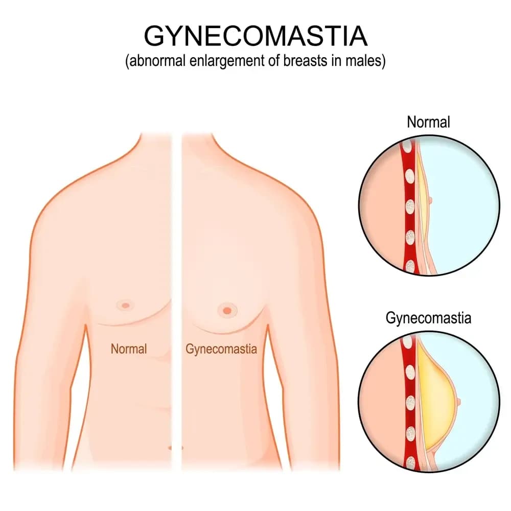 gynecomastia.2.webp