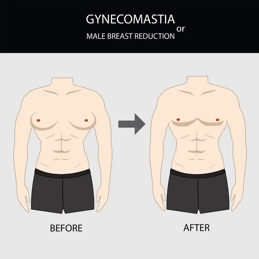 gynecomastia.3.webp