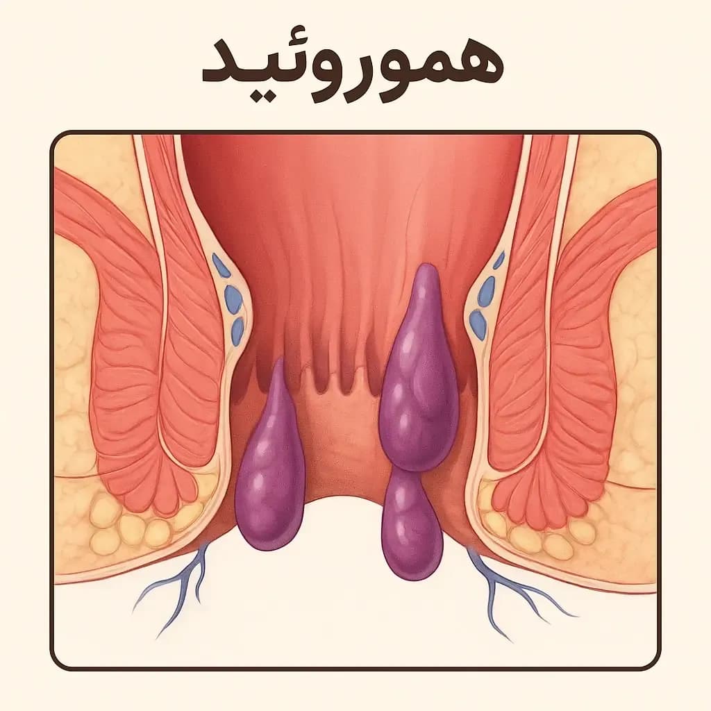 hemorrhoids.231.webp