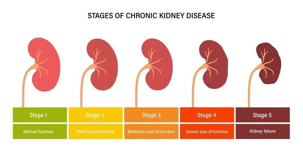 kidney-failure.1.webp