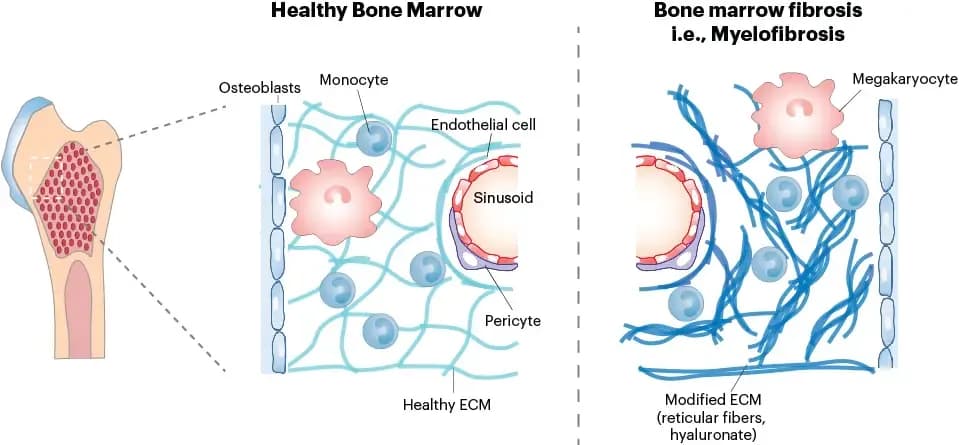 leukemia-type-myelofibrosis.webp
