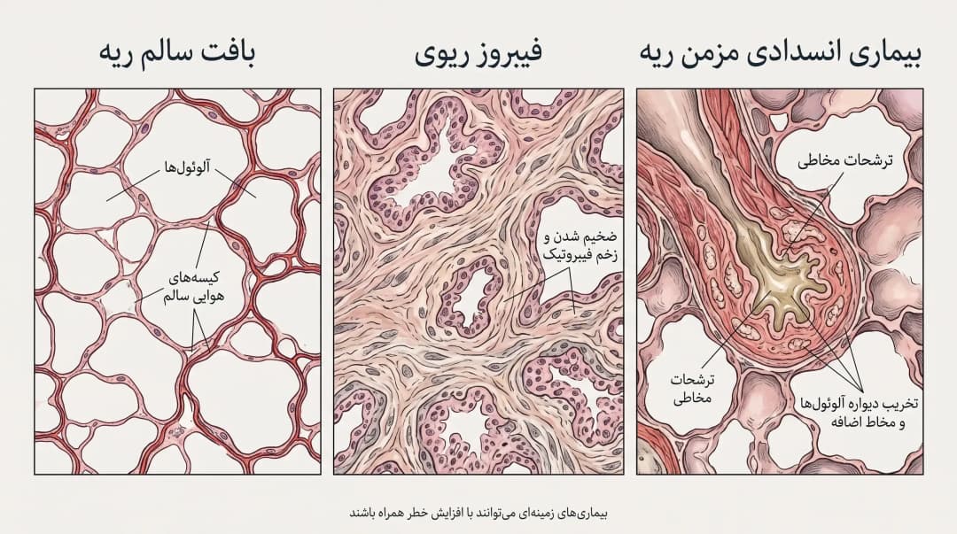 علت سرطان ریه در افراد غیرسیگاری