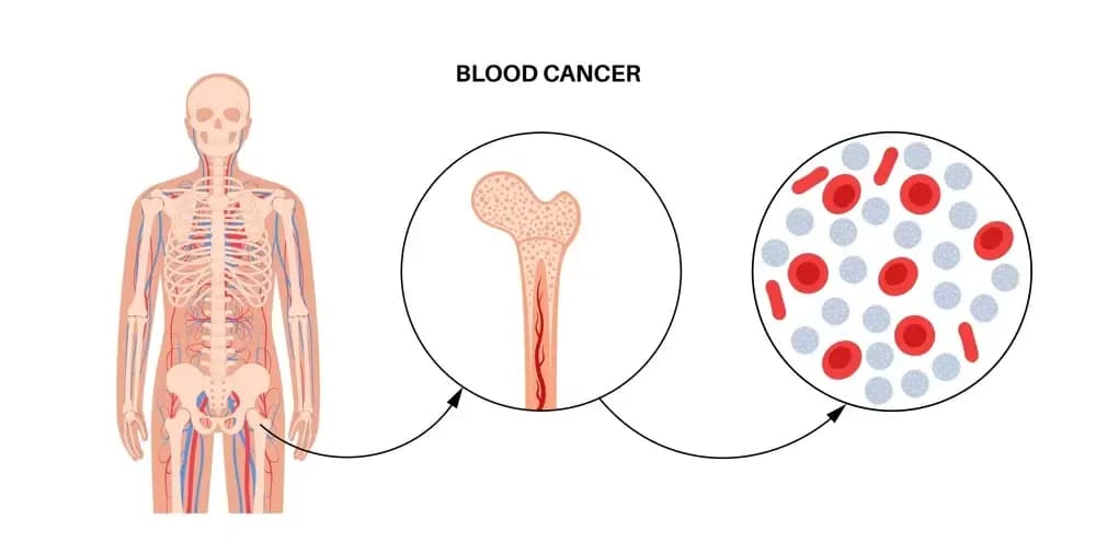 patients-with-CML.webp