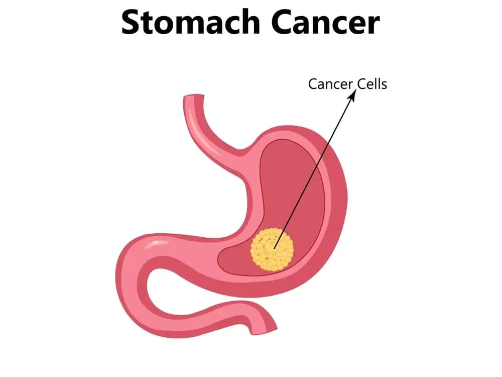 the-best-stomach-cancer-surgeon.webp