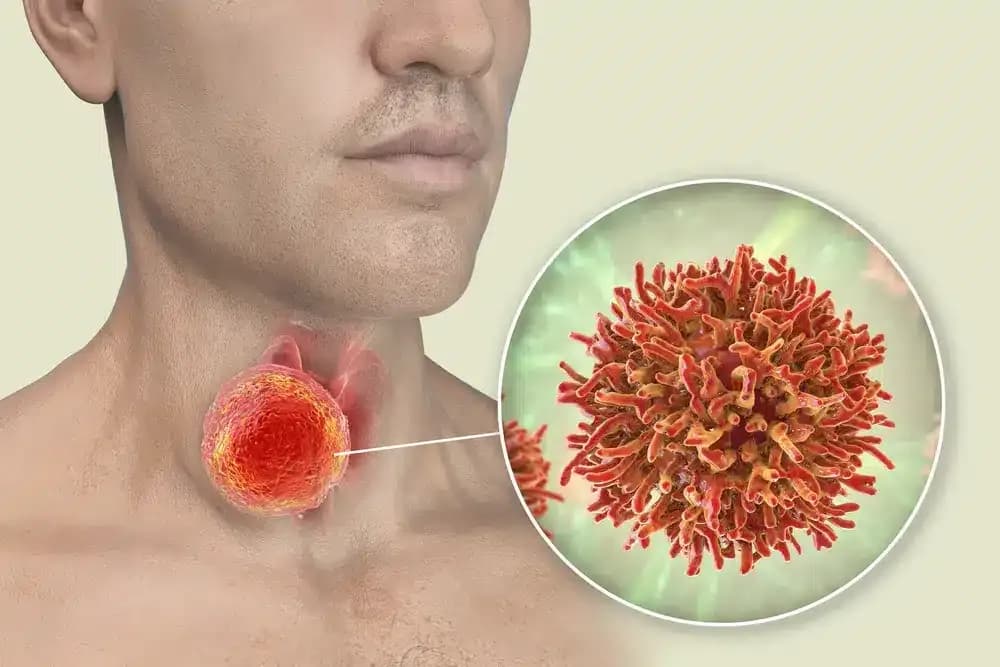 throat-cancer.webp