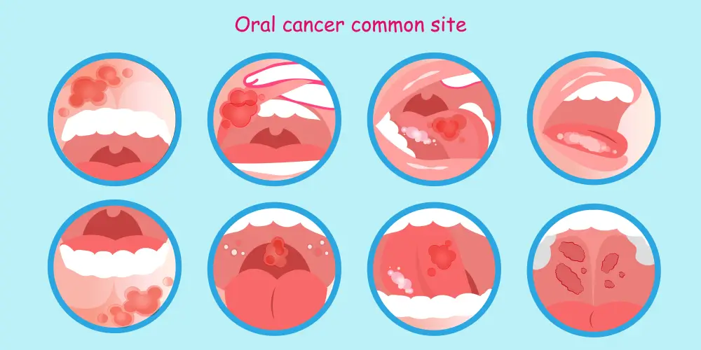علایم سرطان دهان