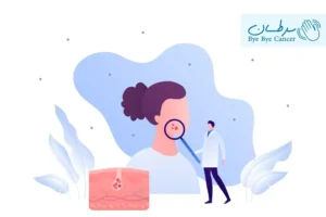 ملانوما