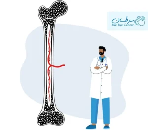 پیوند مغز استخوان