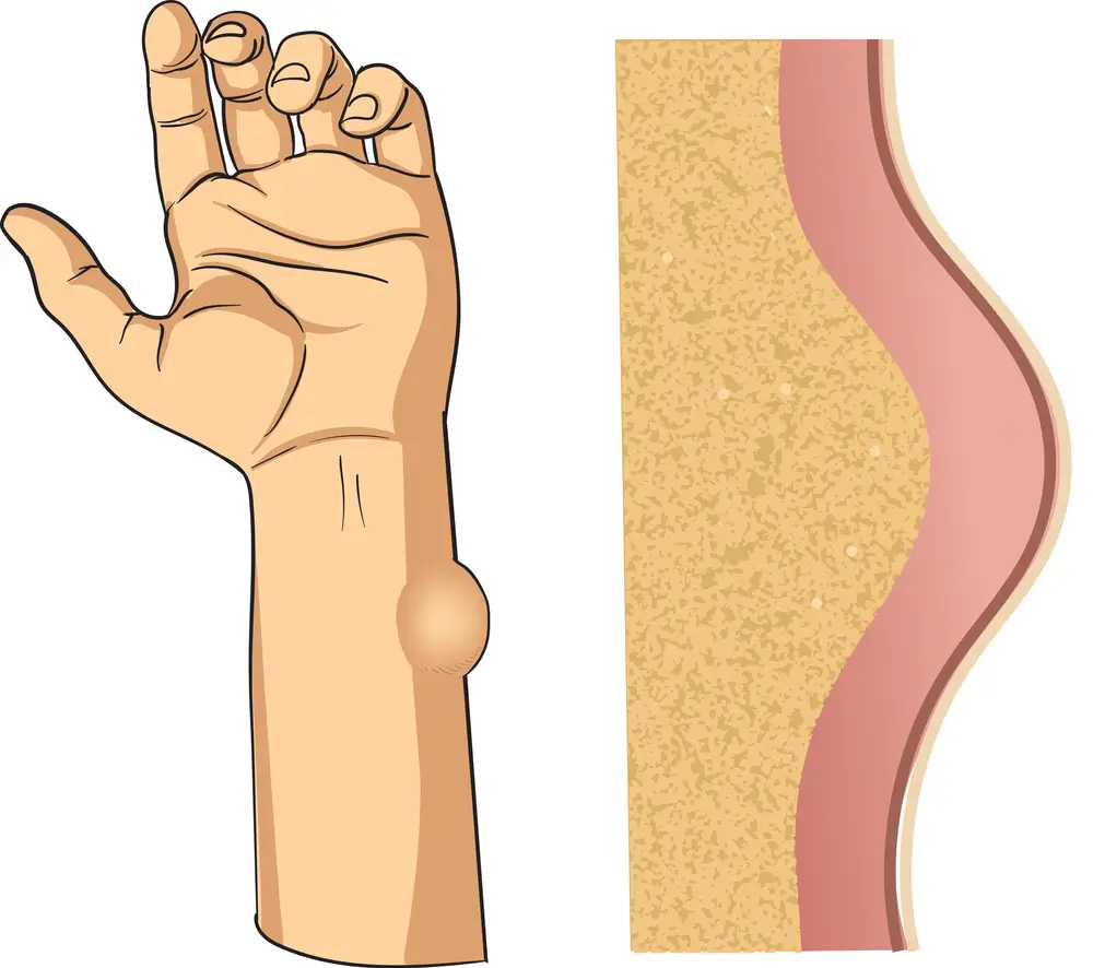 آکرومتاستاتیک