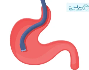تشخیص سرطان معده با اندوسکوپی