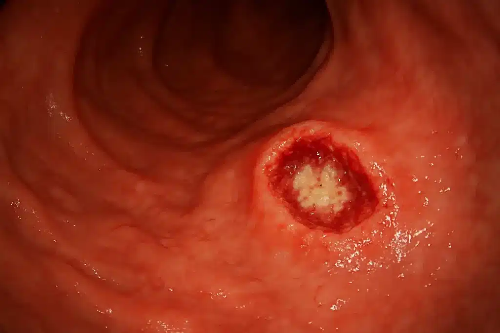 زخم معده و سرطان معده