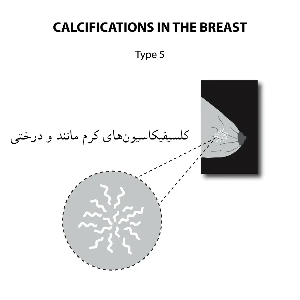 کلسیفیکاسیون پستان