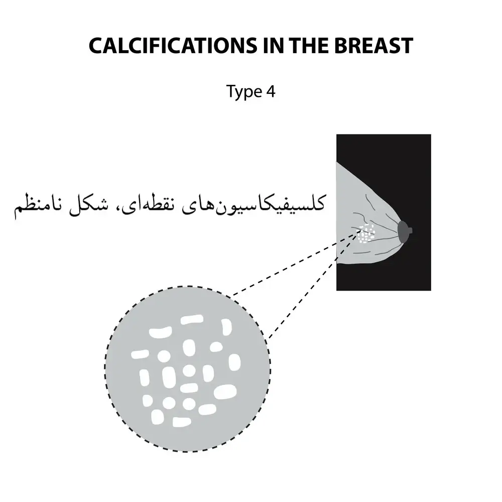 کلسیفیکاسیون در سینه