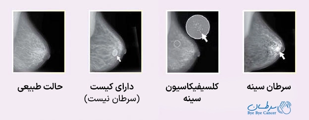شکل توده سرطان سینه